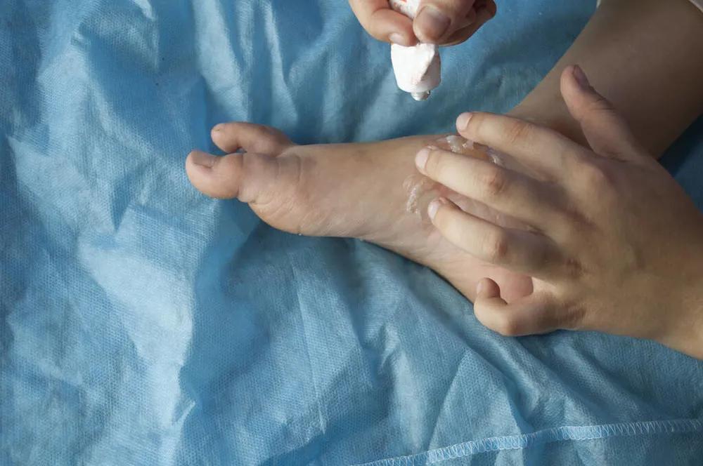 天热有脚气怎么去除脚臭,冬天脚气脚臭怎么办