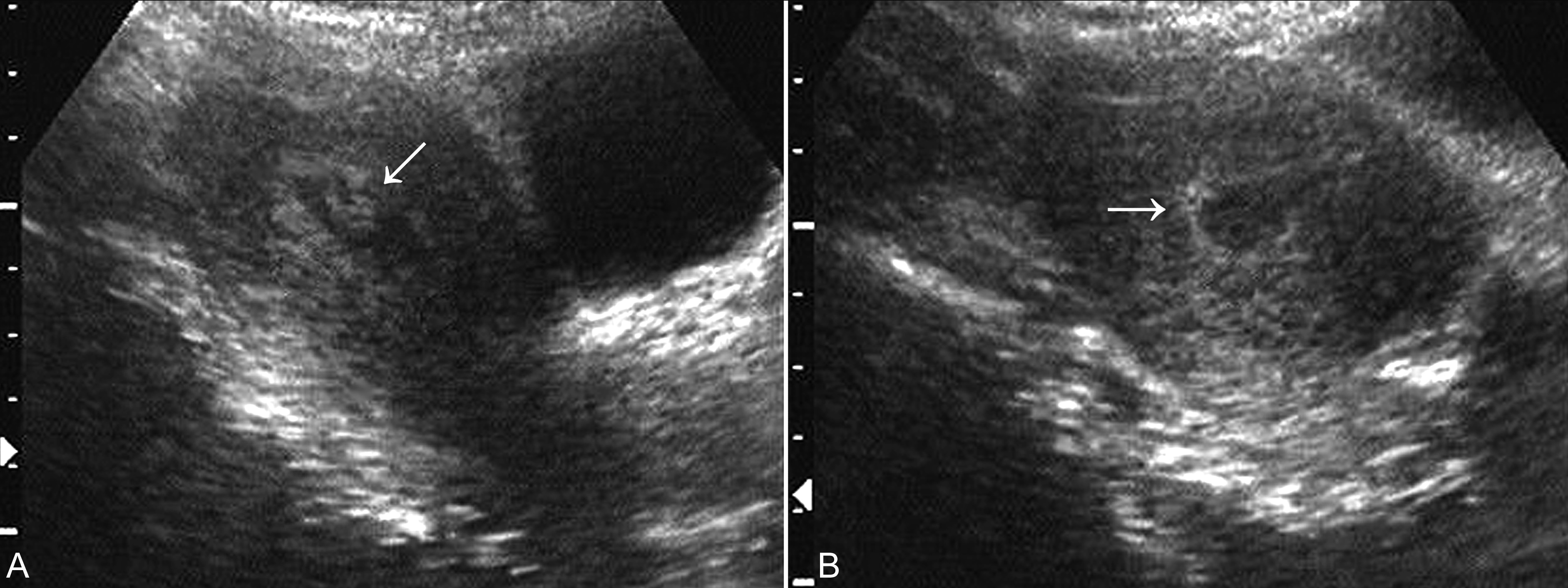 经阴超声检查可以看出来流产吗,流产残留超声诊断