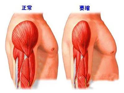 肌肉萎缩症病人视频,专家讲几种肌肉萎缩的症状