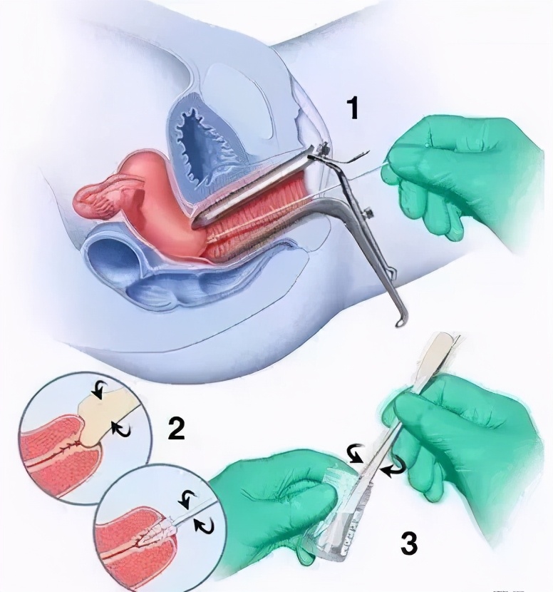 这个「妇科疾病」千万不要乱治！不然会后悔