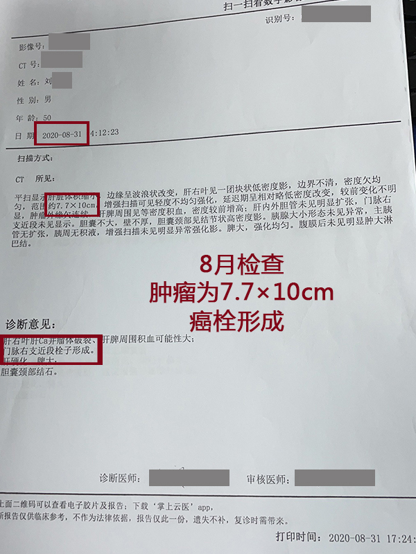 肝癌新发病例,肝癌肿瘤破裂出血会转移吗