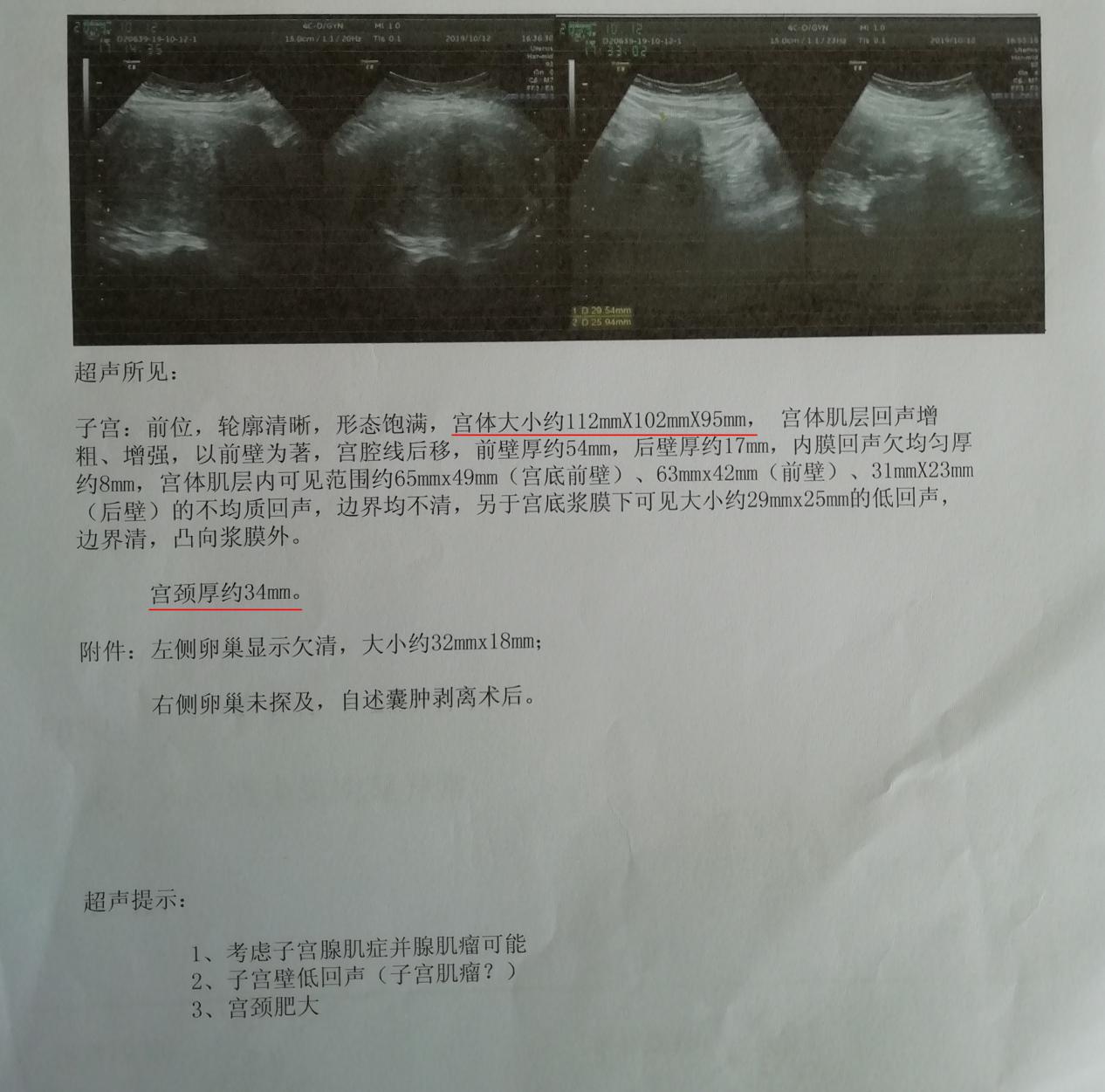 她得了这个怪病后,每次来月经都要用掉15片纸尿裤、60片姨妈巾