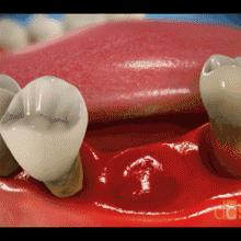 牙龈萎缩怎么办才能快速治愈,出现牙龈萎缩还可以矫正嘛