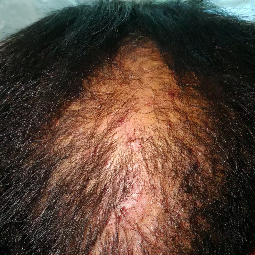 靶向药皮肤副作用怎么缓解,靶向药物副作用引起皮肤溃烂图片