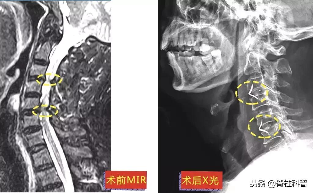 颈椎病治疗的分享,关于颈椎病通俗易懂的科普