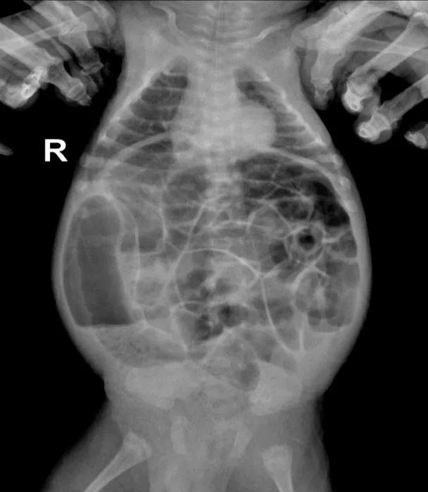 早产宝宝消化不好吃啥好,早产宝宝肠胃不好不长肉