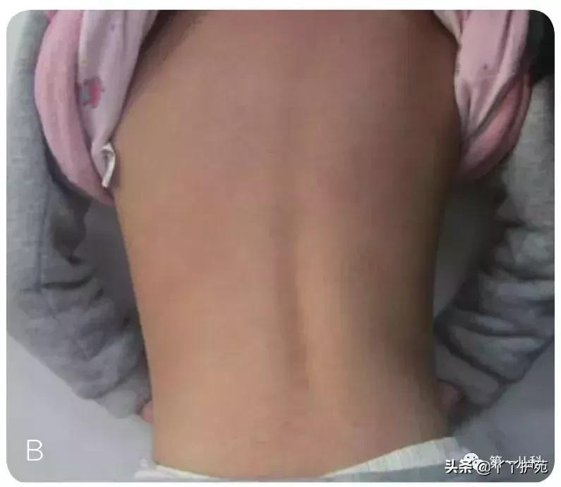 手足口病水痘荨麻疹有什么区别,麻疹水痘手足口病皮疹的区别