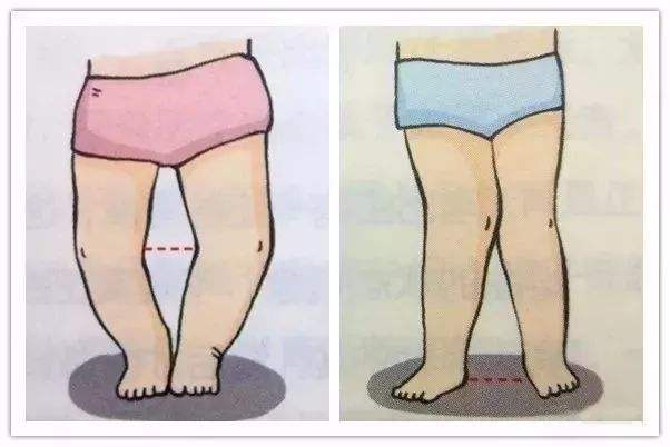 新生儿40天小腿弯曲正常吗,新生儿小腿弯曲什么时候矫正