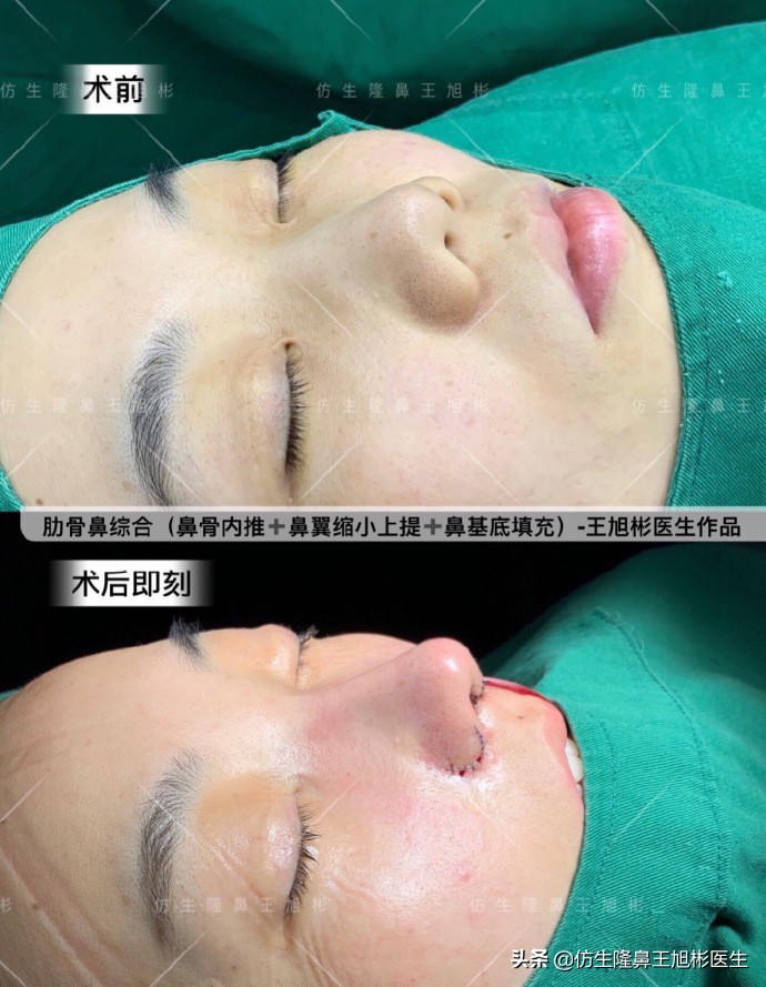 短鼻延长,短鼻塌鼻可以逆袭变长吗