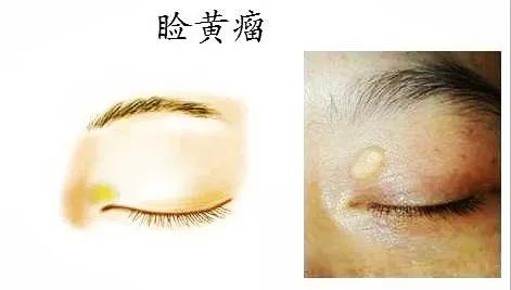 眼角长黄色肉疙瘩，是怎么回事？医生提醒：可能血脂有异常！