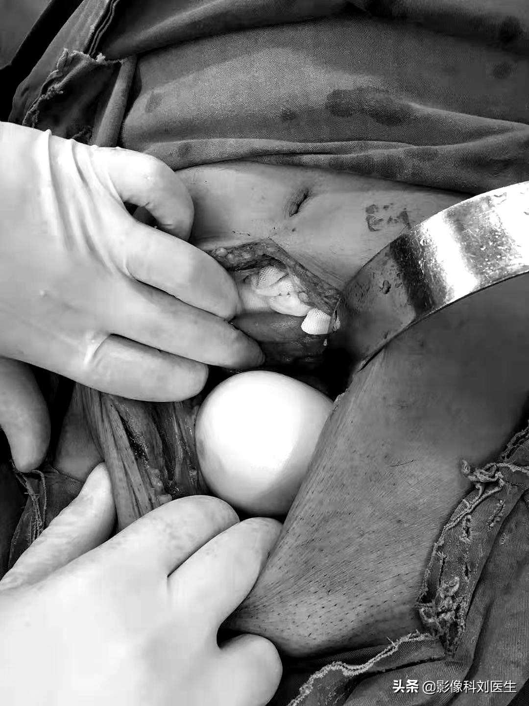 鸭蛋吃多了肚胀气有什么办法,鸭蛋烂在肚子里怎么办