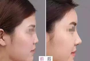 鼻整形后出现肿胀,鼻子整形后假体外露是手术失败吗