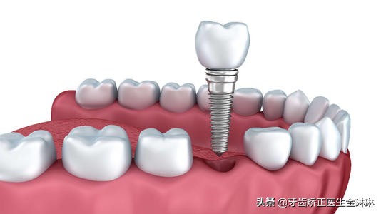 山东正规种植牙一颗大概多少钱,淄博种植牙价格多少钱啊
