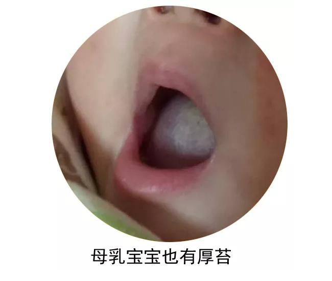 舌苔脉象与病症的关系的对应表,舌苔和病情