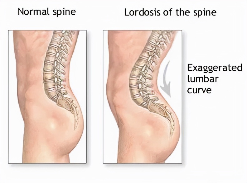 手法治疗中几种常见的姿势异常及评估