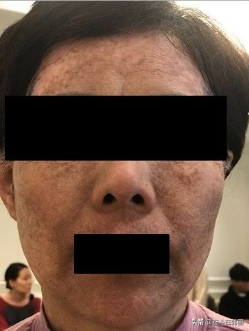 太惨了！这起染发*案惨**在韩国又双叒发生了