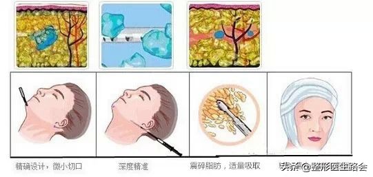 怎么改善大小脸不对称问题,左右脸严重不对称图片怎么改善