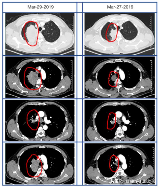 让晚期肺癌活得更精彩,早期肺癌手术治愈是90%吗