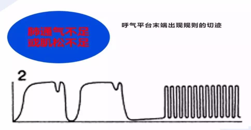 李娟教授：呼气末二氧化碳分压监测的临床应用