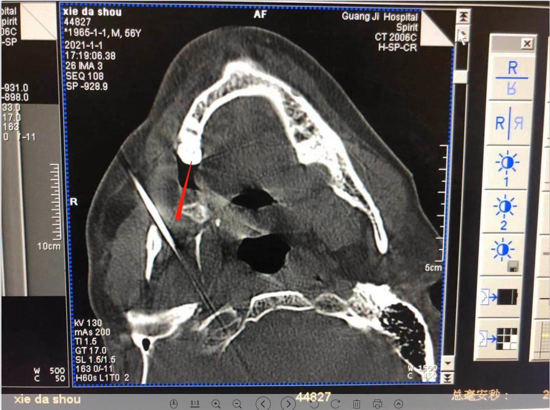 三叉神经慢性疼痛,治好了几十年的三叉神经痛