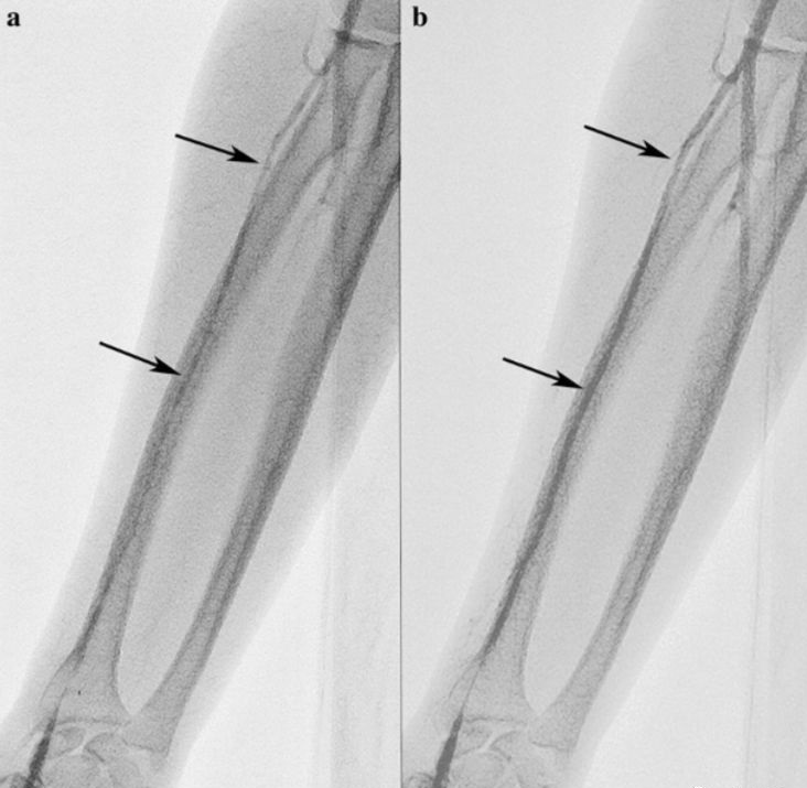 做心脏造影疼不疼?疼痛主要来自于3个方面!医生为你解释清楚