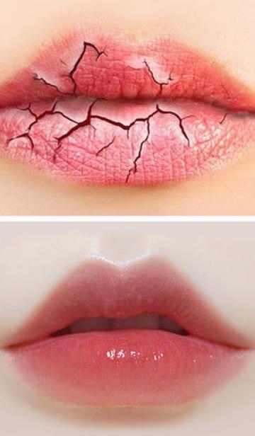 唇纹多怎么改善,唇纹怎么改善医美
