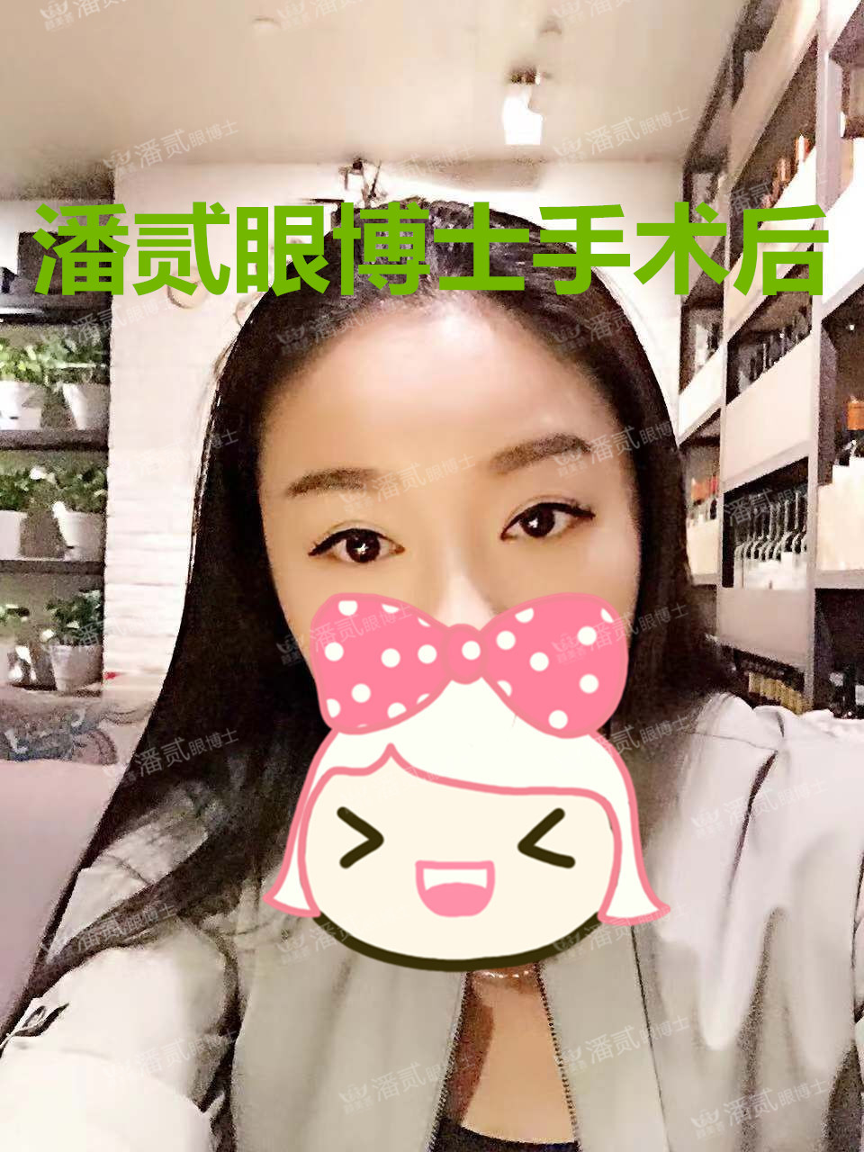 提肌矫正失败的表现眼皮睁不开,做完提肌眼睛前半段下垂