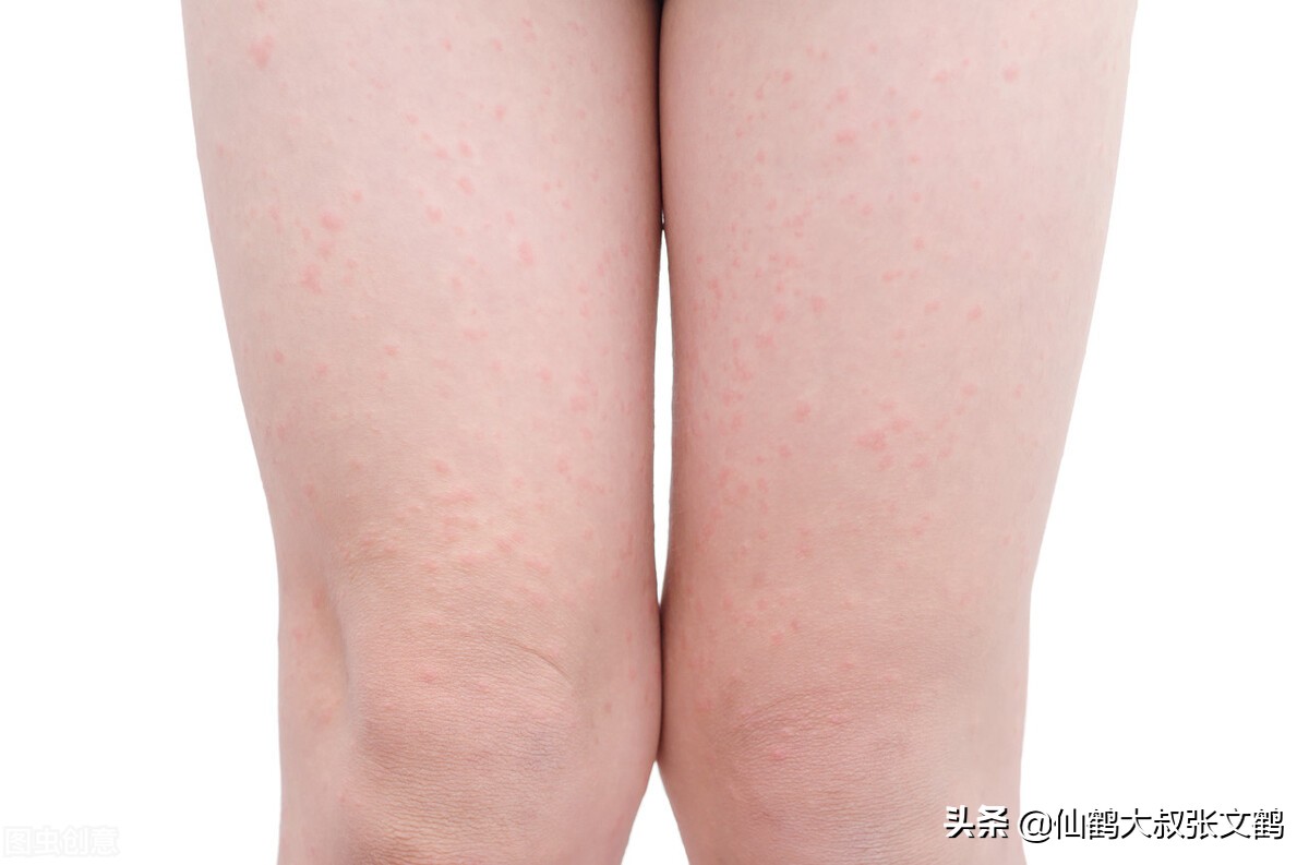 毛周角化症可以用硫磺皂吗,毛周角化症可以用洗面奶吗