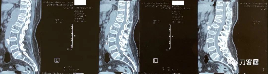 胸椎压缩性骨折病历,脊柱骨质疏松性压缩性骨折