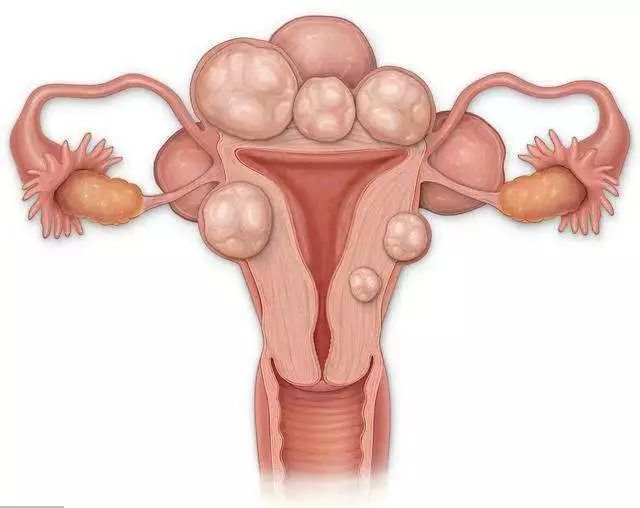 子宫肌瘤的神秘面纱,子宫肌瘤很恐怖只要一招轻松没了