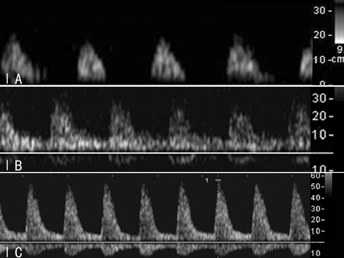 胎儿系统超声检查彩色多普勒,胎儿多普勒超声的一些数据