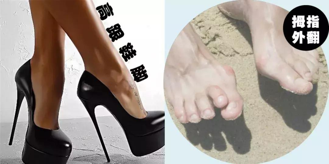 脚拇外翻怎么办教你一招,你的脚好丑的意思