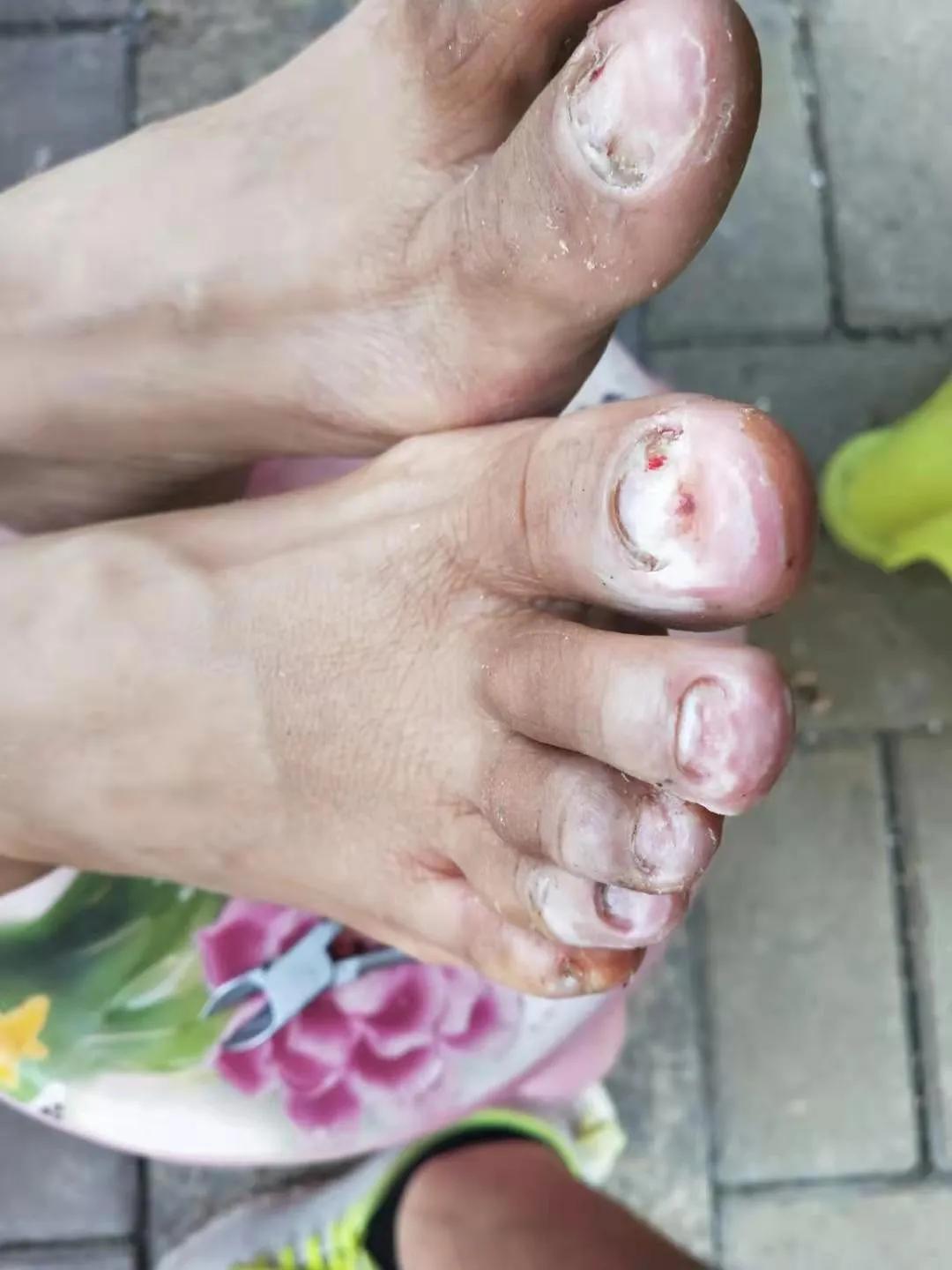 专业修灰指甲,专治鸡眼脚气灰指甲