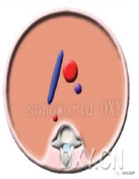 胎儿心脏三种血管关系模式图,25周的胎儿心脏弓切面多少正常
