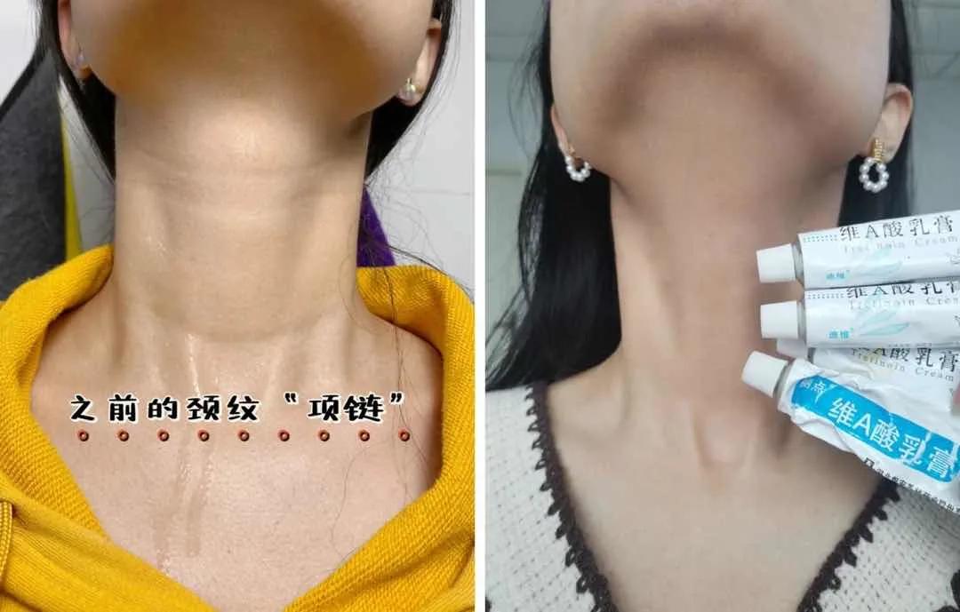 夏天露肉的季节,露肉的正确美白方法