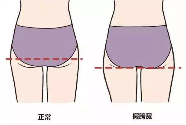 大腿粗屁股肥怎么办,最快最有效改善假胯宽和大腿