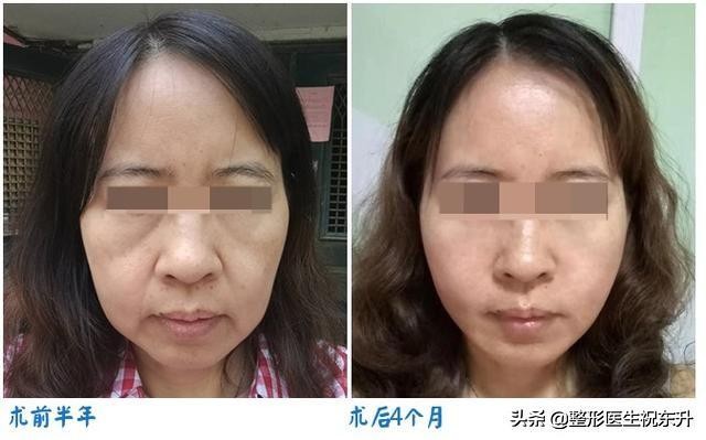 让你80岁都不长皱纹的方法,30-40岁抗皱纹衰老小妙招