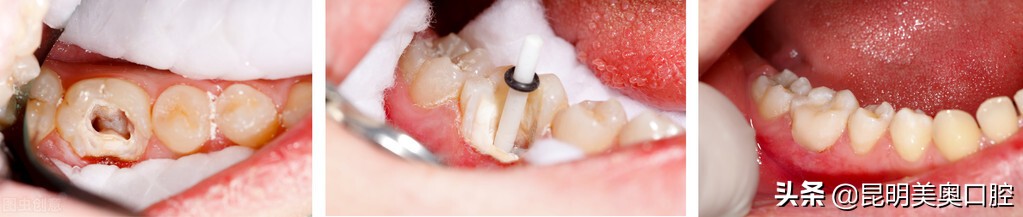 牙齿美白误区有哪些,美白牙齿的误区都有哪些