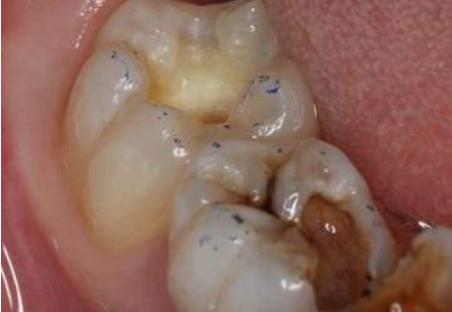 同样是补牙，为什么差距那么大？不同的补牙材料到底该怎么选？