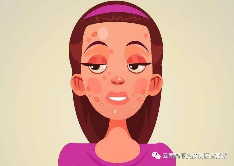 脸上老是长*疮痤**，还一直不好？别急，里面有妙招解决