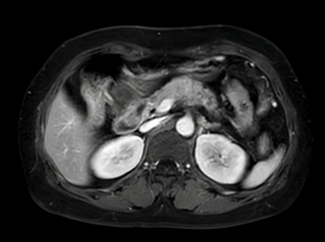 胰腺癌胃痛是什么情况,胃痛和胰腺炎区别与图片
