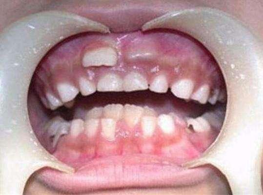 4岁儿童长出“双排牙”不得不一一拔掉！爸妈：只怪我们太宠溺