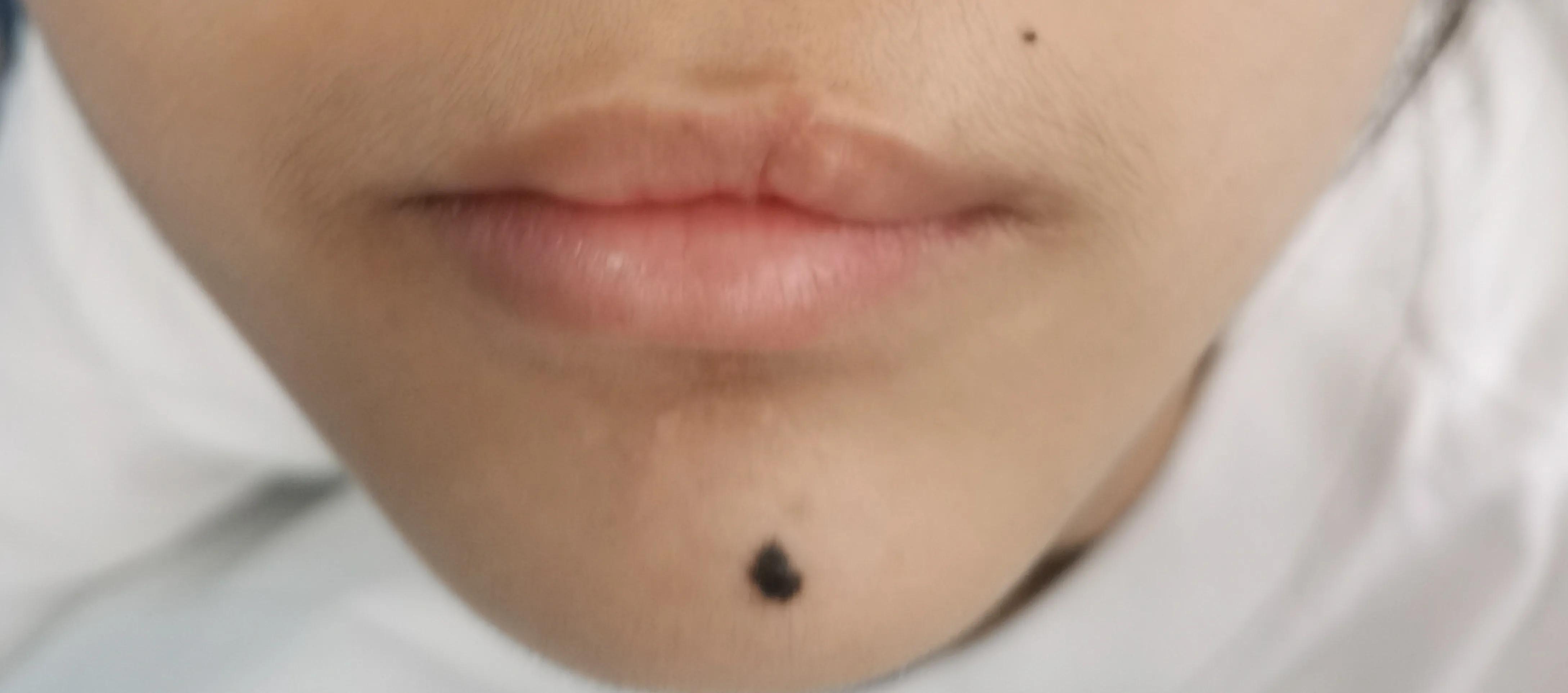 长在皮肤里面的痣激光好祛除吗,去除脸上的痣是冷冻好还是激光好