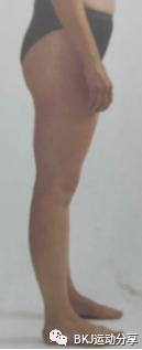 体态矫正之骨盆前倾