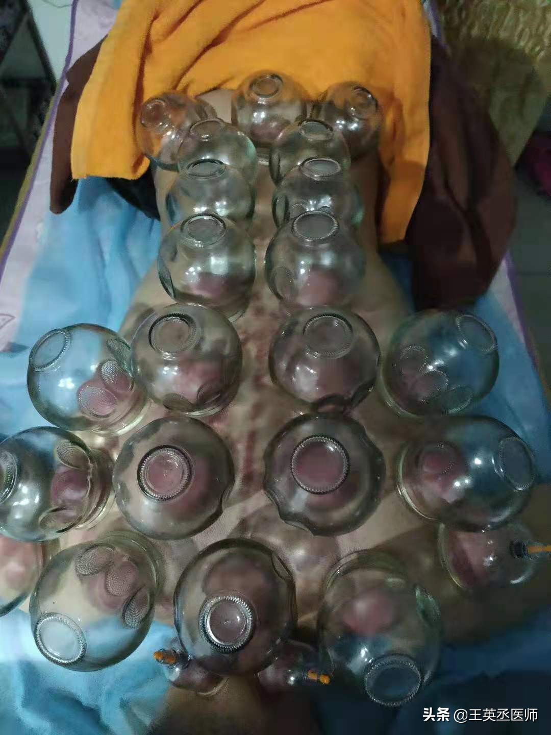 肚脐拔火罐注意事项,背部拔火罐注意事项