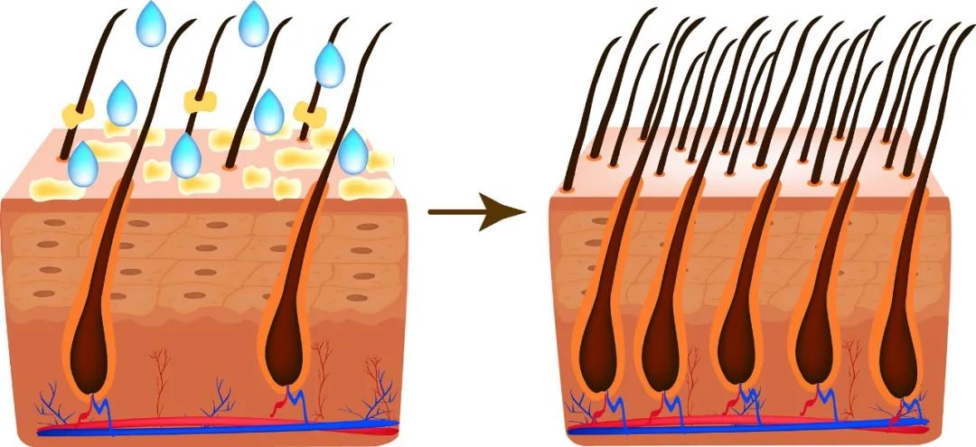 到底是什么原因造成了脱发，为什么头发越来越软