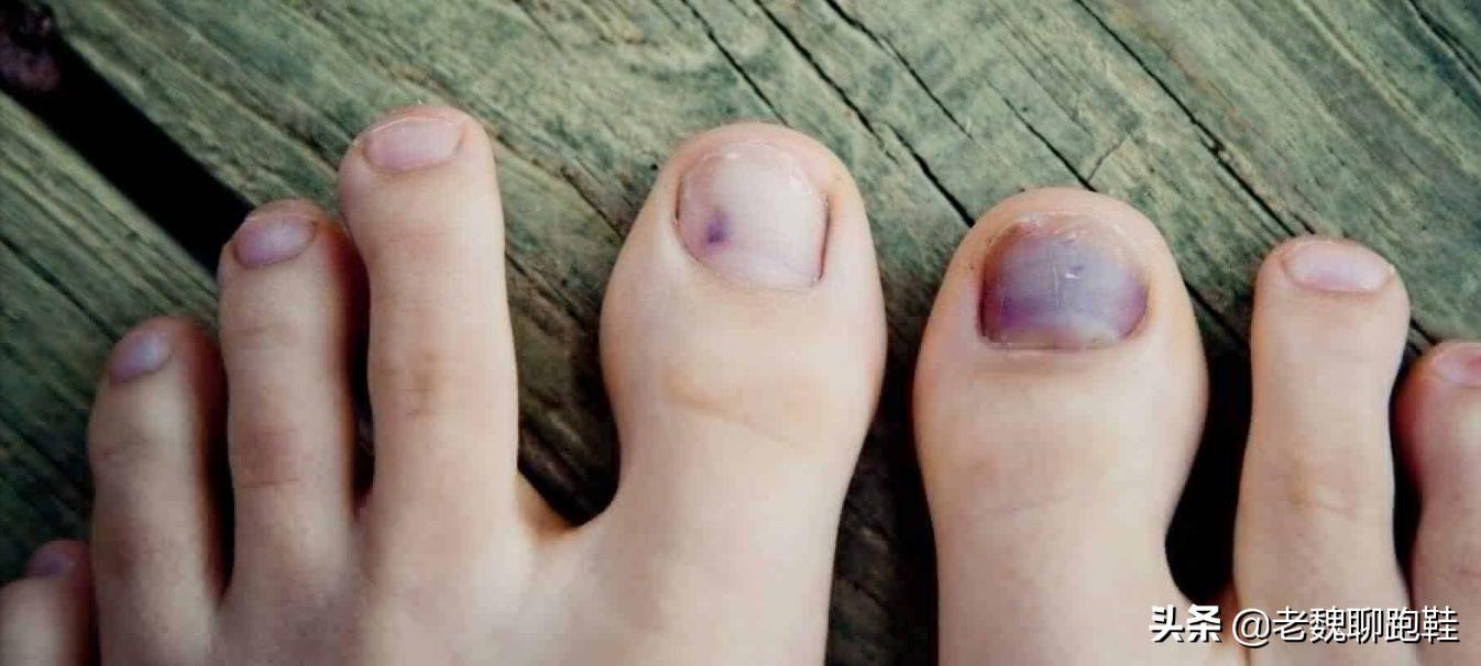 跑步跑到指甲脱落怎么办,跑步指甲黑怎么办