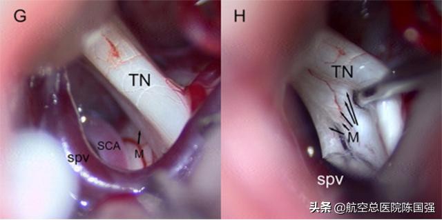 陈国强：令人烦恼的“咬牙切齿”竟是罕见的咬肌痉挛