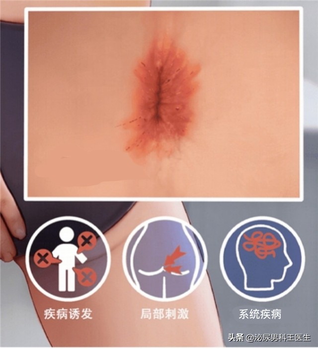 不论男女，若经常“肛门痒”，或许是这3个原因导致，不妨看一下