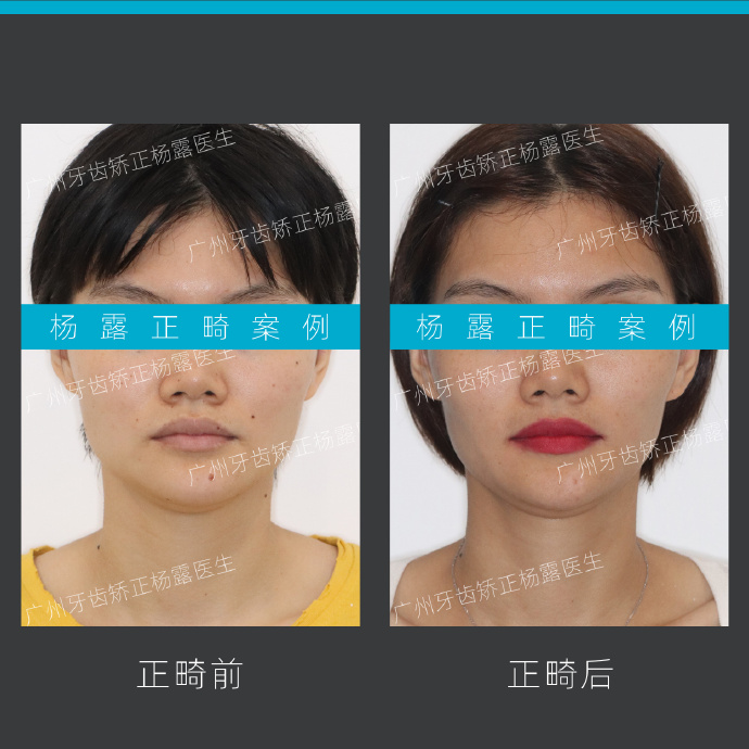 广州牙齿矫正整牙视频,牙齿深覆盖加龅牙怎么矫正